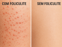 como tratar foliculite