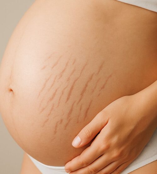 Estrias: por que elas aparecem? Descubra as principais causas estrias porque surgem como evitar